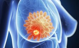 Breast Cancer