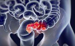 Colorectal Cancer