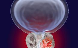 Prostate Cancer